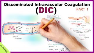 DIC Disseminated Intravascular Coagulation  Part 1 [upl. by Ignacio]