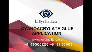 Cyanoacrylate Glue Application [upl. by Lled]