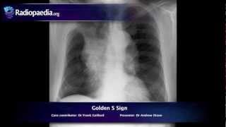 Golden S sign  radiology video tutorial xray [upl. by Esinrahs]