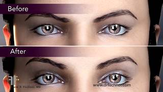 How is a blepharoplasty performed Eyelid Lift Animation by Boston Plastic Surgeon Frank Fechner MD [upl. by Marcellus207]