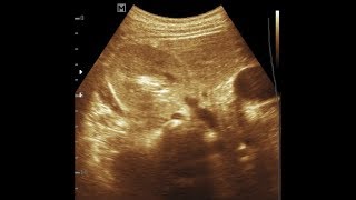 15 years Girl Increase Cortical Echogenicity Right Kidney [upl. by Suvart]