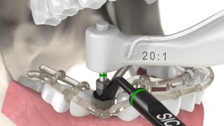 Dental Implantology  Guided Surgery Animation SICace implant insertion [upl. by Aicad]