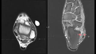 Pain and swelling in lateral ankle from anterior talofibular ligament sprain [upl. by Los961]