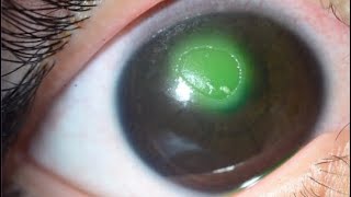 NEUROTROPHIC CORNEAL ULCER [upl. by Mylo]