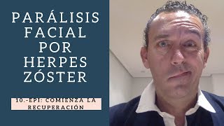 PARÁLISIS FACIAL EPI Comienza la recuperación [upl. by Kreager]