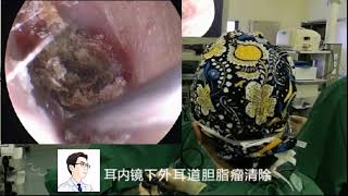 Endoscopic removal of keratosis obturans by Dr Zhao EP1 [upl. by Lever]