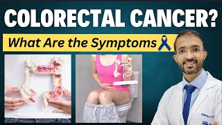 Colorectal Cancer  What Are The Symptoms  Dr Bharat Patodiya [upl. by Acirema692]