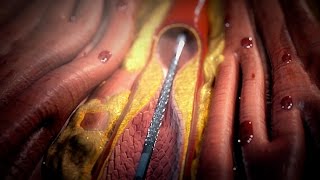 Stent Procedure [upl. by Aicinat]