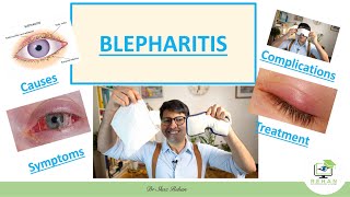 What is Blepharitis How to Treat it Eyelid Hygiene Practices amp How to Prevent it I 2020 Dr Rehan [upl. by Kraus141]