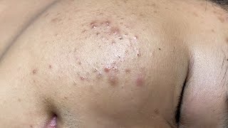 ACNE TREATMENT VU QUYNH MI Acne On Teens Chin 2024 [upl. by Redla]