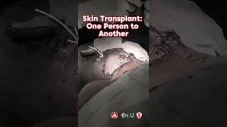 Skin Transplant One Person to Another [upl. by Rialcnis]