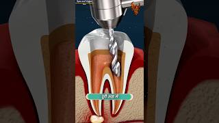 How Root Canal Works 😯  रूट कैनाल कैसे काम करता है  shorts [upl. by Yntrok982]