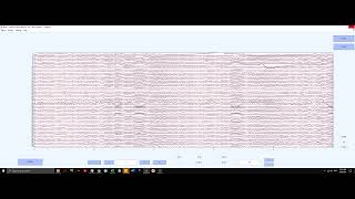 Diagnostics EEG Lumbar Puncture ICP Monitoring  Pediatric Nursing  Nervous System  LevelUpRN [upl. by Hsemin]