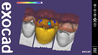 exocad Video Tutorial Basic Features  Anatomic Coping with Cutback [upl. by Ettennej]