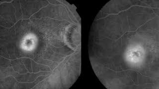 FFA CLASSIFICATION OF CNVM Choroidal neovascular membrane  Occult vs Classic CNVM [upl. by Leahcam]