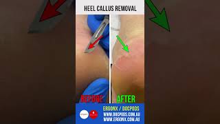 Heel Callus Removal [upl. by Milly]