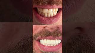 Hollywood smile is your ticket to an extraordinary transformation dental hollywoodsmile teeth [upl. by Judie476]