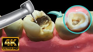 Endodoncia en muela con caries profunda  Tratamiento de conducto [upl. by Nylak]