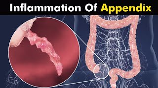 What Happens inAppendicitis  Inflammation Of Appendix [upl. by Tihom]