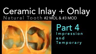 Lithium Disilicate Ceramics Part 4 Impression and Temporary [upl. by Ainivad]