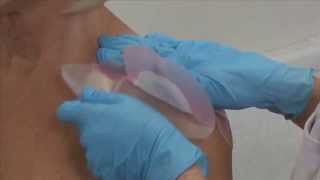 ALLEVYN Gentle Border Multisite application to the shoulder [upl. by Learsi]