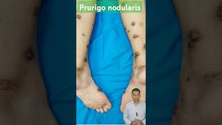 PRURIGO NODULARIS शरीर पर खुजली और गांठें  dryskin itching nodules shortsfeed ytshorts short [upl. by Yrret]