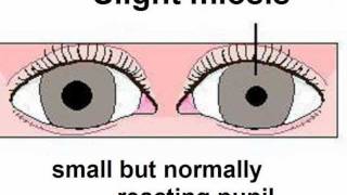 Syndromes of the ANS  Part 4  Horners Syndrome [upl. by Ranna]