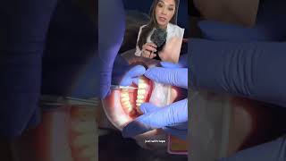 Changing composite veneers to porcelain veneers compositeveneers porcelainveneers smilemakeover [upl. by Fineman]