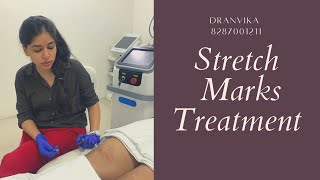 3 Best Stretch marks treatment🤩  Laser for stretch marks [upl. by Mccullough532]