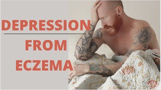 Is Healing Eczema Causing You Stress Anxiety Depression How to overcome eczema related Stress [upl. by Wulfe407]