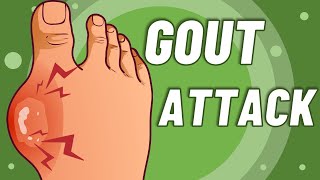 Living With Gout  Lifestyle Recommendations 2 of 6 [upl. by Hertzfeld]