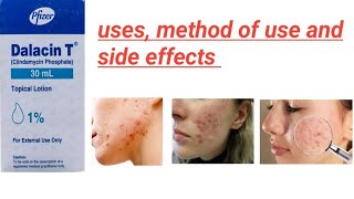 Dalacin T lotion uses and method of use in Urdu best for acne used on dr prescription only [upl. by Afas]