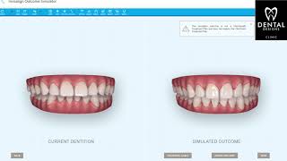 Invisalign Outcome Simulator  Invisalign Singapore by Dental Designs Clinic [upl. by Nivi]