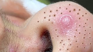 Big Cystic Acne Blackheads Extraction Blackheads amp Milia Whiteheads Removal Pimple Popping  376 [upl. by Nawj]