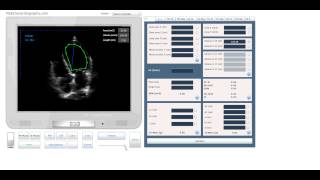 LV Ejection fractionEF wwwMyEchocardiographycom [upl. by Oranneg]