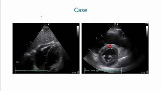 An Athletes Battle with Constrictive Pericarditis [upl. by Dahraf321]