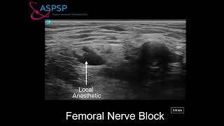 Ultrasound Guided Femoral Nerve Block In a Patient With Vascular Stent [upl. by Meggi]