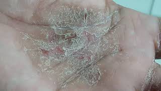 Palmar Keratoderma Shocked to read its incurable [upl. by Jolynn]