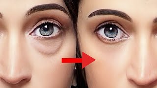 Remove Eye Bags Dark Circles Swelling Under Eyes Naturally Get Amazing Result Reverse your Age [upl. by Eilliw]