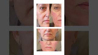 Get younger looking skin with BIOLIFT facial treatment  CARE Esthetics [upl. by Lindbom39]