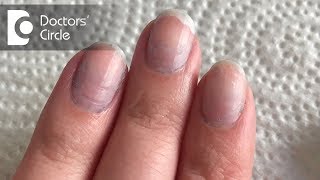 What causes bluish discoloration of nail beds  Dr Rashmi Ravindra [upl. by Valerye411]