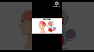 Meningitis disease detailed key notes with pictures 💃💃✅✅ medicalcollegelife [upl. by Aizirk700]