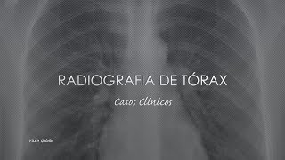 Radiografia de Tórax Casos Clínicos [upl. by Angle]