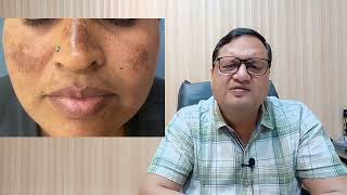 Pigmentation Treatment Price  Laser Pigmentation Treatment  Causes  Kayakalp Laser Clinic [upl. by Skyler]