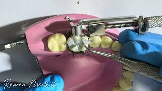 Class ll Amalgam Restoration  in Lower 6  Dr Rawan Medhat  شرح بالعربي [upl. by Ahsinnek]