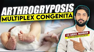 Understanding Arthrogryposis Multiplex Congenita Causes Symptoms and Treatment Options [upl. by Demaggio427]