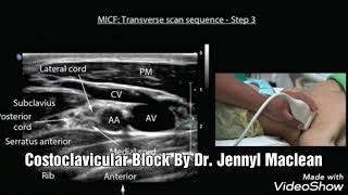 Costoclavicular Block [upl. by Ahsilra630]