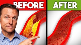 Best Nutrients to Remove Plaque from Arteries [upl. by Woodie820]