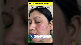 Scarless mole removal  By Dr Uttam Kumar Lenka MBBS MD Consultant Dermatologist [upl. by Hilario]