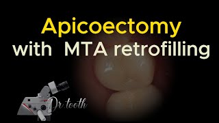 Apicoectomy with retrograde MTA filling 치근단 절제술 [upl. by Nolla]